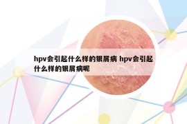 hpv會引起什么樣的銀屑病 hpv會引起什么樣的銀屑病呢