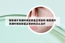 銀屑病不發(fā)病時候皮膚是正常的嗎 銀屑病不發(fā)病時候皮膚是正常的嗎怎么治療