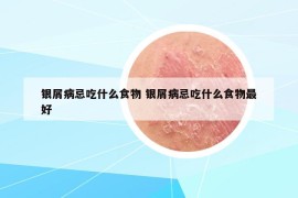 銀屑病忌吃什么食物 銀屑病忌吃什么食物最好