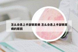 怎么會(huì)患上手部銀屑病 怎么會(huì)患上手部銀屑病的原因