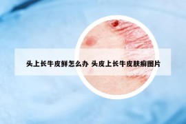 頭上長(zhǎng)牛皮鮮怎么辦 頭皮上長(zhǎng)牛皮膚癬圖片