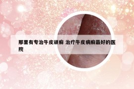 那里有專治牛皮頑癬 治療牛皮病癬最好的醫(yī)院