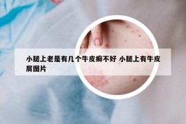 小腿上老是有幾個(gè)牛皮癬不好 小腿上有牛皮屑圖片