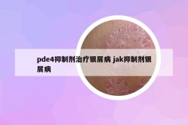 pde4抑制劑治療銀屑病 jak抑制劑銀屑病