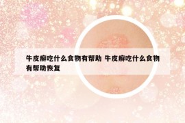 牛皮癬吃什么食物有幫助 牛皮癬吃什么食物有幫助恢復(fù)