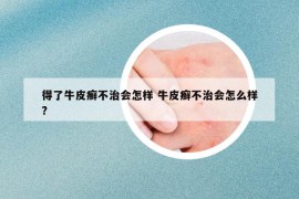 得了牛皮癬不治會怎樣 牛皮癬不治會怎么樣?