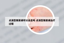 點滴型銀屑病可以自愈嗎 點滴型銀屑病治療過程