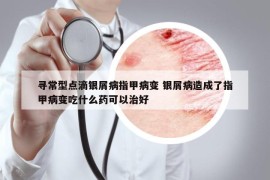 尋常型點(diǎn)滴銀屑病指甲病變 銀屑病造成了指甲病變吃什么藥可以治好