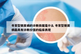 尋常型銀屑病的診斷依據(jù)是什么 尋常型銀屑病最具有診斷價值的臨床表現(xiàn)