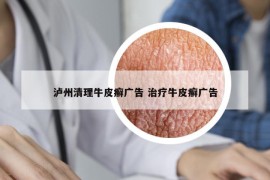 瀘州清理牛皮癬廣告 治療牛皮癬廣告