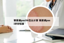 銀屑病pasi90怎么計(jì)算 銀屑病pasi評(píng)分標(biāo)準(zhǔn)