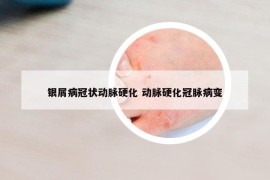 銀屑病冠狀動脈硬化 動脈硬化冠脈病變