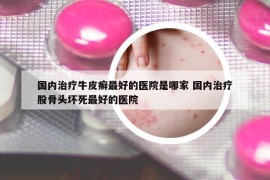 國內(nèi)治療牛皮癬最好的醫(yī)院是哪家 國內(nèi)治療股骨頭壞死最好的醫(yī)院