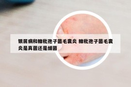 銀屑病和糠秕孢子菌毛囊炎 糠秕孢子菌毛囊炎是真菌還是細菌