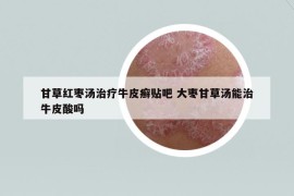 甘草紅棗湯治療牛皮癬貼吧 大棗甘草湯能治牛皮酸嗎