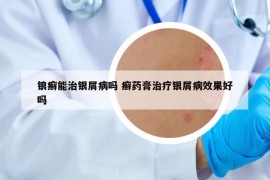 鋃癬能治銀屑病嗎 癬藥膏治療銀屑病效果好嗎