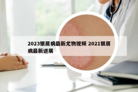 2023銀屑病最新尤物視頻 2021銀屑病最新進(jìn)展