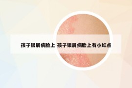 孩子銀屑病臉上 孩子銀屑病臉上有小紅點