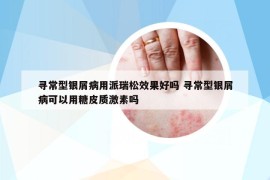 尋常型銀屑病用派瑞松效果好嗎 尋常型銀屑病可以用糖皮質(zhì)激素嗎