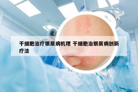 干細(xì)胞治療銀屑病機(jī)理 干細(xì)胞治銀屑病創(chuàng)新療法
