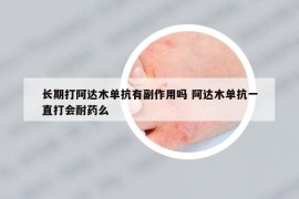 長(zhǎng)期打阿達(dá)木單抗有副作用嗎 阿達(dá)木單抗一直打會(huì)耐藥么