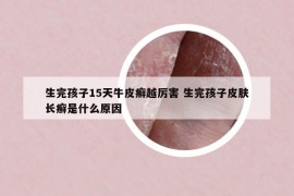 生完孩子15天牛皮癬越厲害 生完孩子皮膚長癬是什么原因