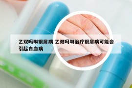乙雙嗎啉銀屑病 乙雙嗎啉治療銀屑病可能會(huì)引起白血病