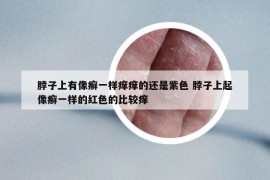 脖子上有像癬一樣癢癢的還是紫色 脖子上起像癬一樣的紅色的比較癢