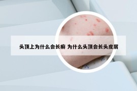 頭頂上為什么會(huì)長癬 為什么頭頂會(huì)長頭皮屑