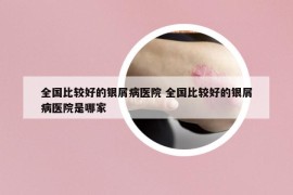 全國比較好的銀屑病醫(yī)院 全國比較好的銀屑病醫(yī)院是哪家