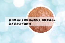 得銀屑病的人是不是有寄生蟲(chóng) 患銀屑病的人是不是身上有真菌呀