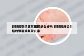 鏈球菌數(shù)值正常銀屑病會好嗎 鏈球菌感染引起的銀屑病復(fù)發(fā)幾率