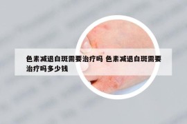 色素減退白斑需要治療嗎 色素減退白斑需要治療嗎多少錢
