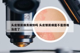 頭皮銀屑病發(fā)病快嗎 頭皮銀屑病是不是很難治愈了