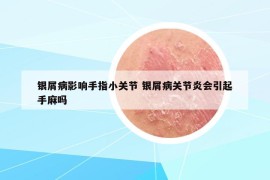 銀屑病影響手指小關(guān)節(jié) 銀屑病關(guān)節(jié)炎會引起手麻嗎