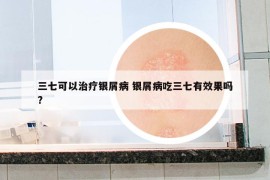 三七可以治療銀屑病 銀屑病吃三七有效果嗎?