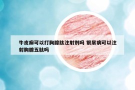 牛皮癬可以打胸腺肽注射劑嗎 銀屑病可以注射胸腺五肽嗎