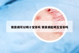 銀屑病可以喝十寶茶嗎 銀屑病能喝五寶茶嗎