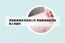 掌跖膿皰病會傳染別人嗎 掌跖膿皰病會傳染別人嗎圖片