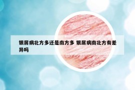 銀屑病北方多還是南方多 銀屑病南北方有差異嗎