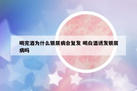 喝完酒為什么銀屑病會(huì)復(fù)發(fā) 喝白酒誘發(fā)銀屑病嗎