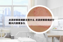點(diǎn)滴狀銀屑病都注意什么 點(diǎn)滴狀銀屑病進(jìn)行期大約需要多久