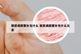 銀屑病需要補充什么 銀屑病需要補充什么元素