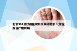 北京301皮膚病醫(yī)院銀屑病紅糖水 北京醫(yī)院治療銀屑病