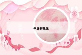牛皮癬隱血