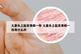兒童頭上起皮像癬一樣 兒童頭上起皮像癬一樣用什么藥