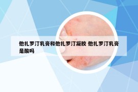 他扎羅汀乳膏和他扎羅汀凝膠 他扎羅汀乳膏是酸嗎