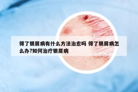 得了銀屑病有什么方法治愈嗎 得了銀屑病怎么辦?如何治療銀屑病