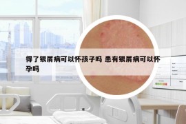 得了銀屑病可以懷孩子嗎 患有銀屑病可以懷孕嗎