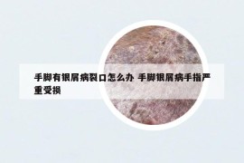 手腳有銀屑病裂口怎么辦 手腳銀屑病手指嚴(yán)重受損